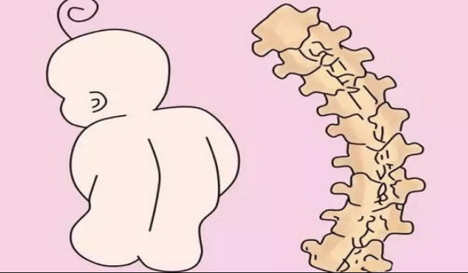 Nhận biết vẹo cột sống ở trẻ sơ sinh