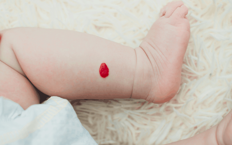 Bướu máu ở lòng bàn tay ở trẻ có nên mổ không?