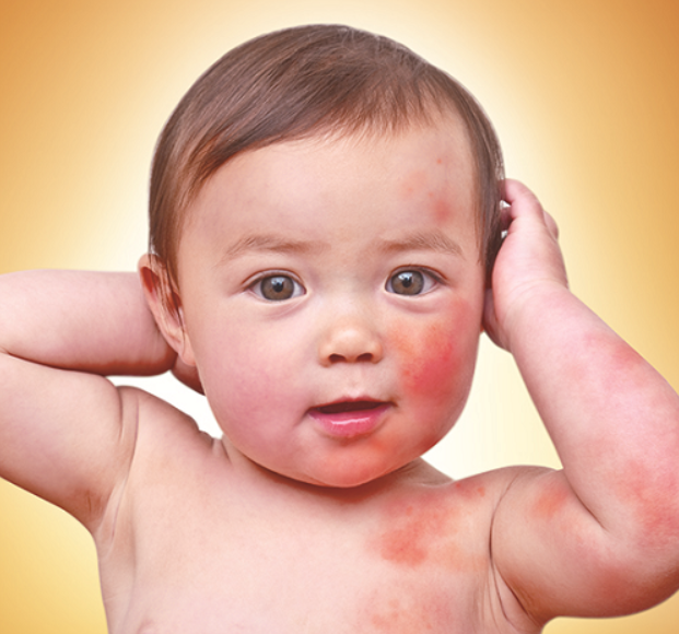 Có cách nào để phòng tránh bệnh lupus ban đỏ ở trẻ sơ sinh? 
