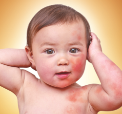 Vì sao trẻ bị dị ứng đạm sữa bò?
