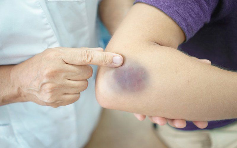Tìm hiểu rối loạn giảm tiểu cầu ở trẻ em