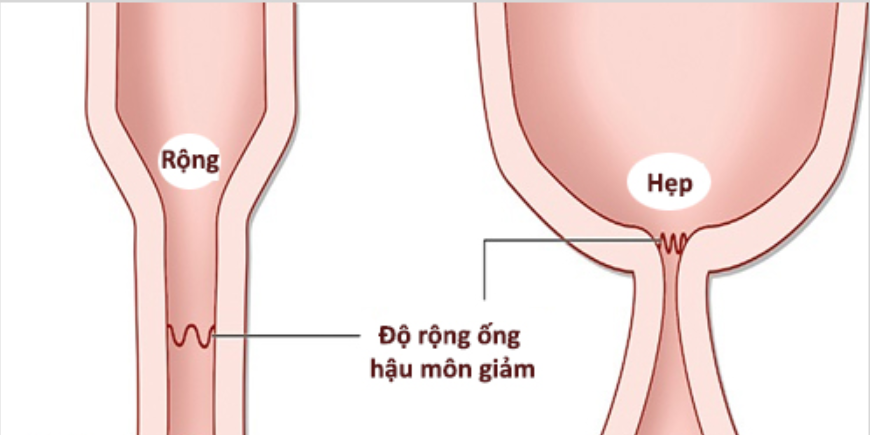 Nong hậu môn cho trẻ sơ sinh