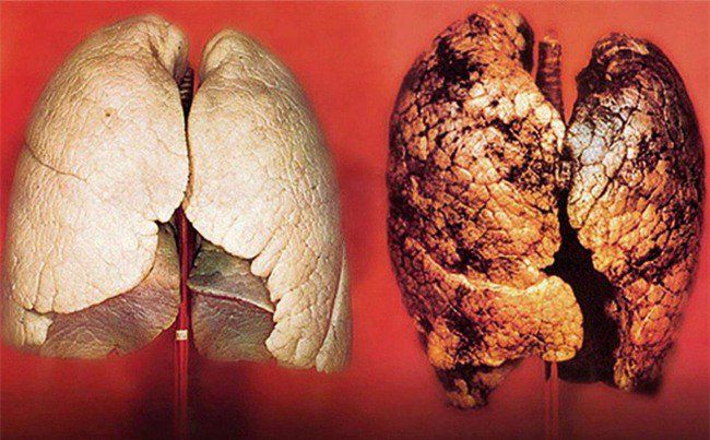 Bệnh xơ phổi ở trẻ sinh non: Triệu chứng, chẩn đoán và điều trị