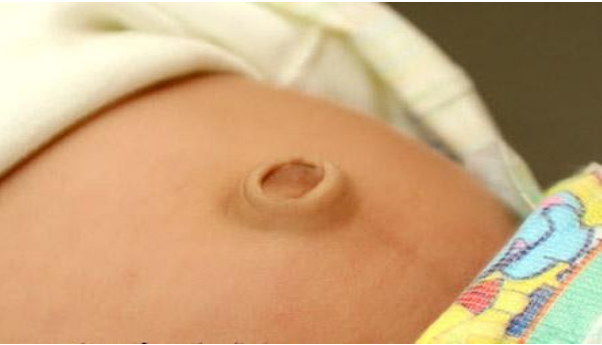 Những bệnh lý về rốn ở trẻ sơ sinh