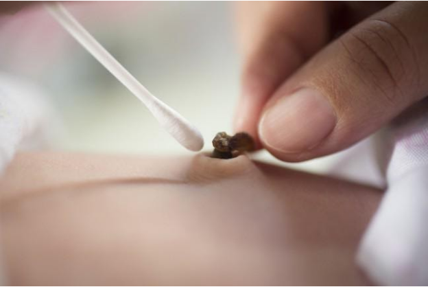 Những bệnh lý về rốn ở trẻ sơ sinh