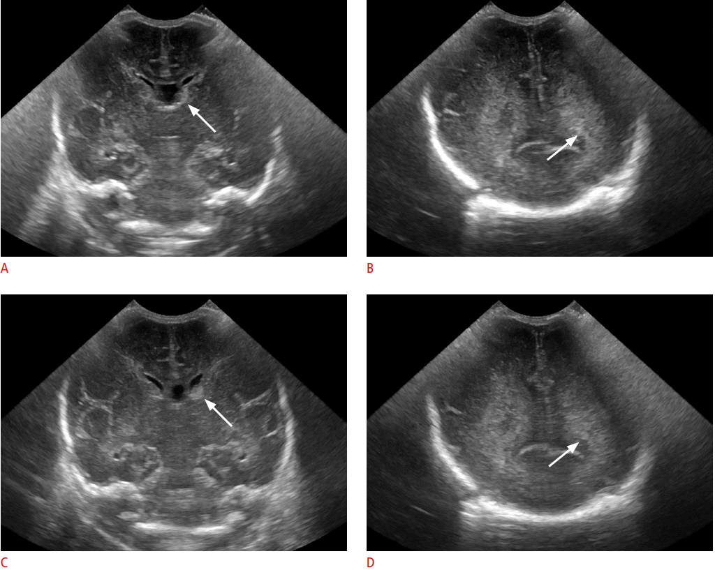 Siêu âm qua thóp ở trẻ em