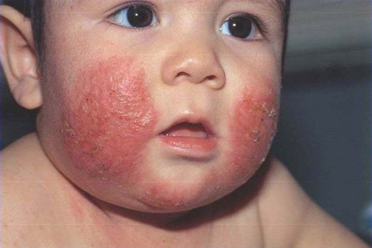 Nuôi con bằng sữa mẹ hoàn toàn trong 3 tháng giúp giảm nguy cơ mắc bệnh chàm mãn tính