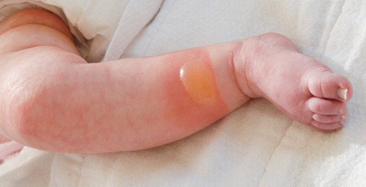 Những tai nạn thường gặp ở trẻ nhỏ và cách phòng tránh