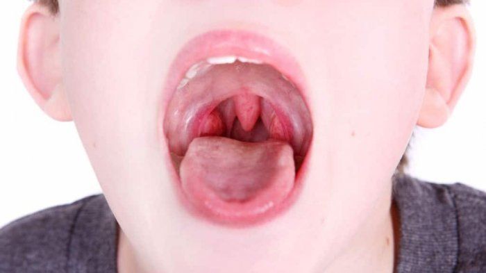 Đau họng ở trẻ sơ sinh và trẻ mới biết đi