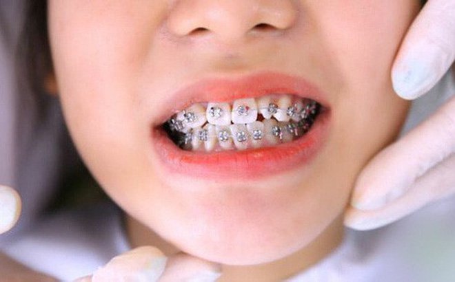 Trẻ em nên niềng răng khi nào?