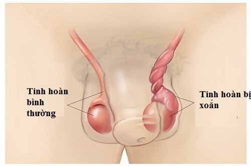 Xoắn tinh hoàn ở trẻ sơ sinh: Nguyên nhân, triệu chứng và cách điều trị