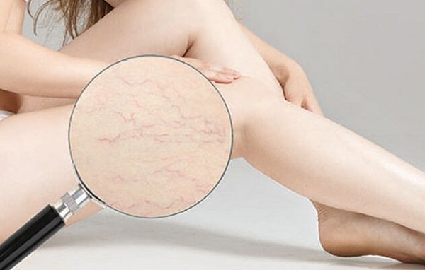 Tại sao rạn da ngực thường xuất hiện ở vùng ngực so với các vùng khác trên cơ thể?
