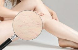 Bị rạn da tuổi dậy thì có hết không?