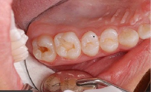Cách chăm sóc nướu và răng mới mọc của bé
