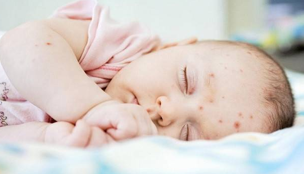 Cách chăm sóc trẻ bị nhọt