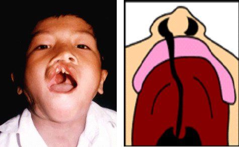 Khe hở chéo mặt: Những điều cần biết