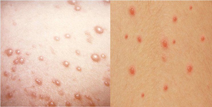 Chốc lở trên da trẻ nhỏ: Điều trị thế nào?