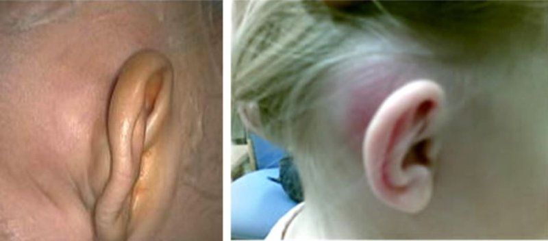 Chẩn đoán viêm tai xương chũm cấp tính ở trẻ nhỏ