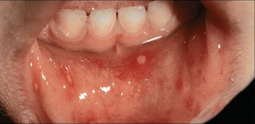 Quan sát hình ảnh bệnh tay chân miệng ở trẻ em