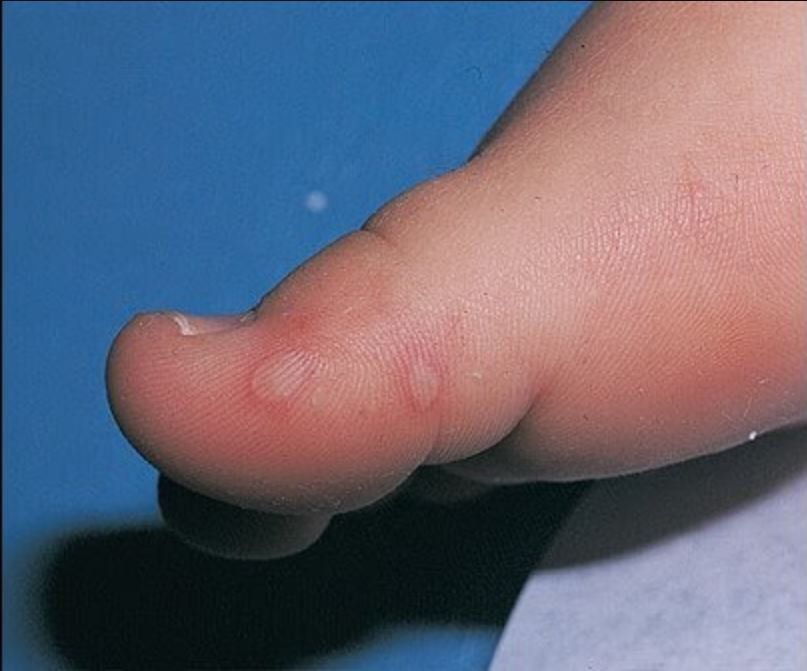 Quan sát hình ảnh bệnh tay chân miệng ở trẻ em