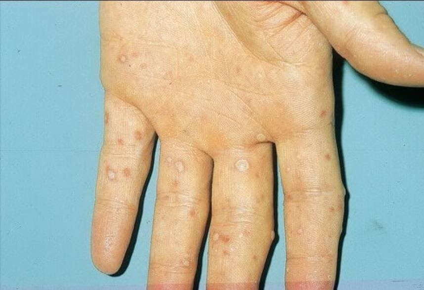 Quan sát hình ảnh bệnh tay chân miệng ở trẻ em