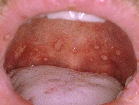 Quan sát hình ảnh bệnh tay chân miệng ở trẻ em