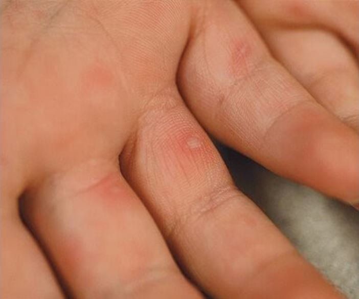 Quan sát hình ảnh bệnh tay chân miệng ở trẻ em