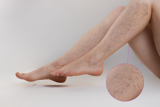 Điều trị giãn tĩnh mạch ở bà mẹ sau khi sinh con