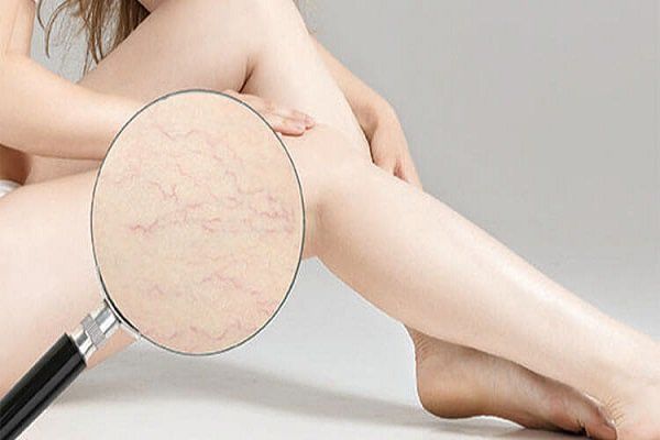 Điều trị giãn tĩnh mạch ở bà mẹ sau khi sinh con