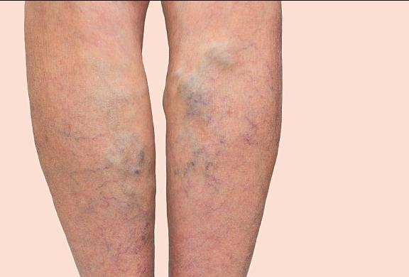 Điều trị giãn tĩnh mạch ở bà mẹ sau khi sinh con