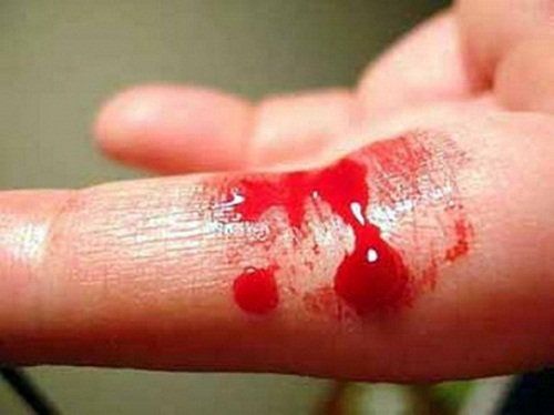 Bệnh Hemophilia là bệnh gì?