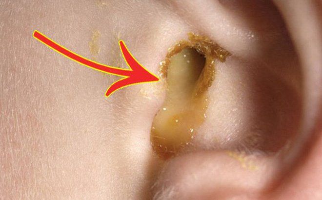 Viêm tai ngoài ở trẻ em: Nguyên nhân, cách điều trị