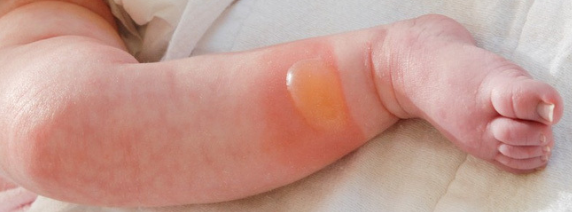 Bỏng ở trẻ: Mức độ, cách điều trị và phòng ngừa