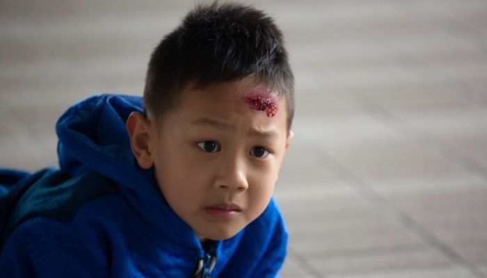 Trẻ em ngã đập đầu xuống đất có sao không?