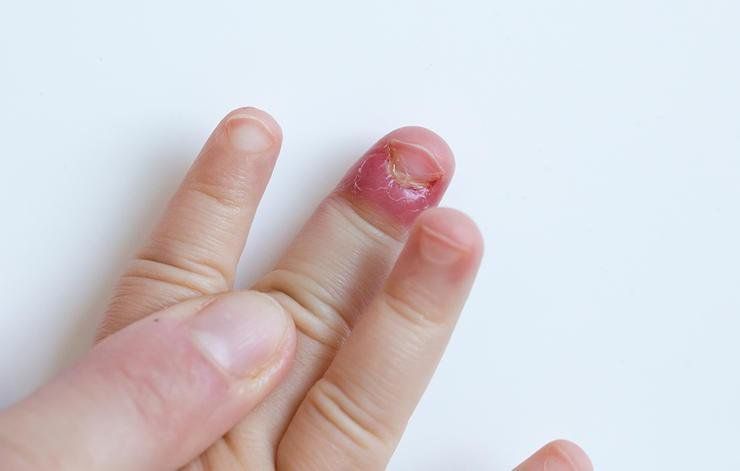 Vì sao trẻ 'nghiện' cắn móng tay?