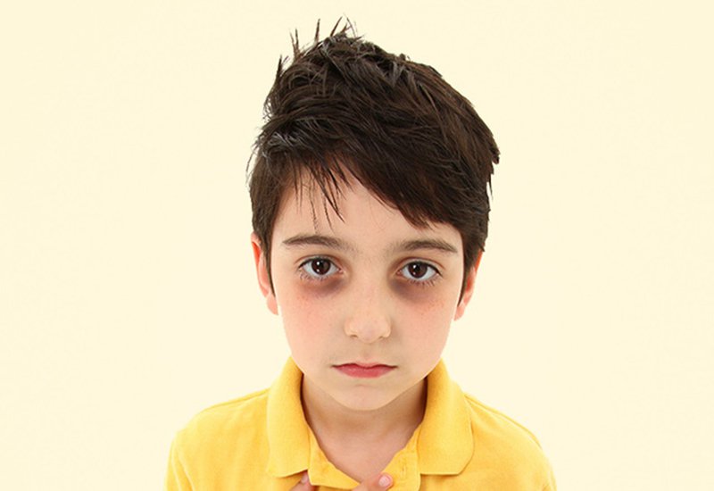 Thâm quầng mắt có thể xuất hiện ở trẻ em từ độ tuổi nào và liệu có gì phải lo ngại?
