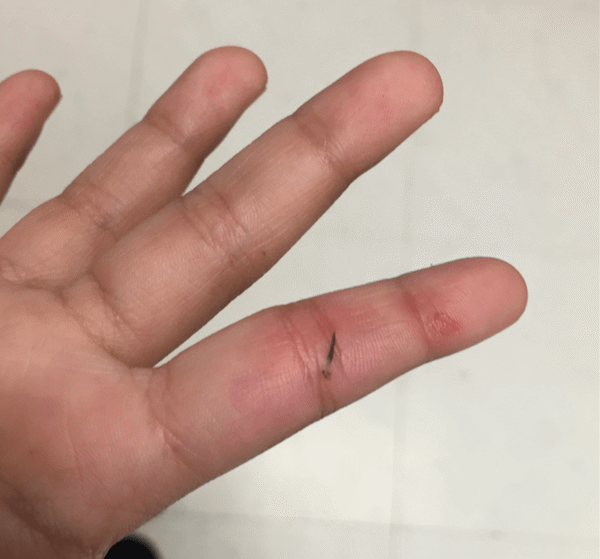 Làm thế nào để loại bỏ mảnh dằm đâm vào tay trẻ?