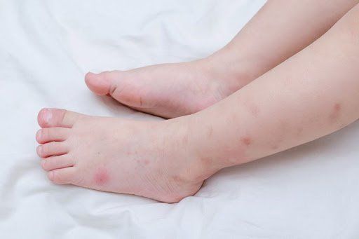 Trẻ bị bọ ve cắn: Cách xử lý
