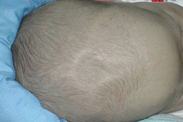 Thóp lõm ở trẻ sơ sinh cảnh báo điều gì?