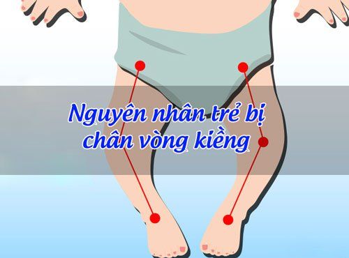 Làm cách nào để biết trẻ có bị chân vòng kiềng hay không?