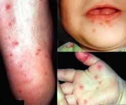 Bệnh chân tay miệng có lây không? Lây đường nào?