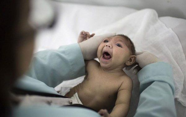 Teo não ở trẻ sơ sinh có nguy hiểm?