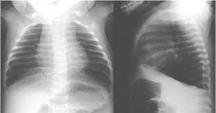 Thông sàn nhĩ thất ở trẻ sơ sinh