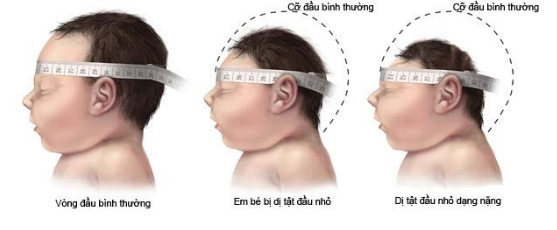 Tật đầu nhỏ ở thai nhi - Những điều mẹ bầu cần biết