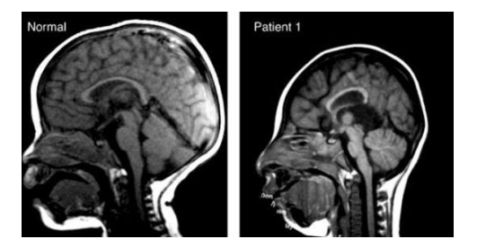Tật đầu nhỏ ở thai nhi - Những điều mẹ bầu cần biết
