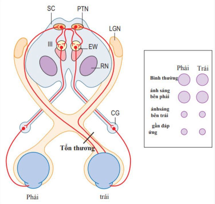 Sụp mí ở trẻ sơ sinh: Nguyên nhân và cách xử trí