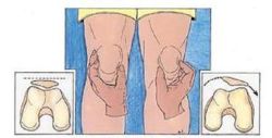 Trật xương bánh chè bẩm sinh và phẫu thuật điều trị