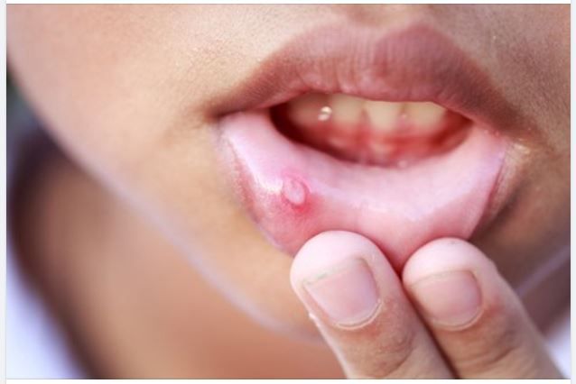 MÁCH BẠN MẸO NHỎ ĐIỀU TRỊ NHIỆT MIỆNG TẠI NHÀ