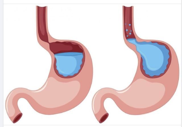 CHUYÊN GIA BẬT MÍ DẤU HIỆU NHẬN BIẾT SỚM TRÀO NGƯỢC DẠ DÀY THỰC QUẢN