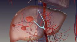 Chẩn đoán và điều trị u máu gan - bệnh viện Việt Đức